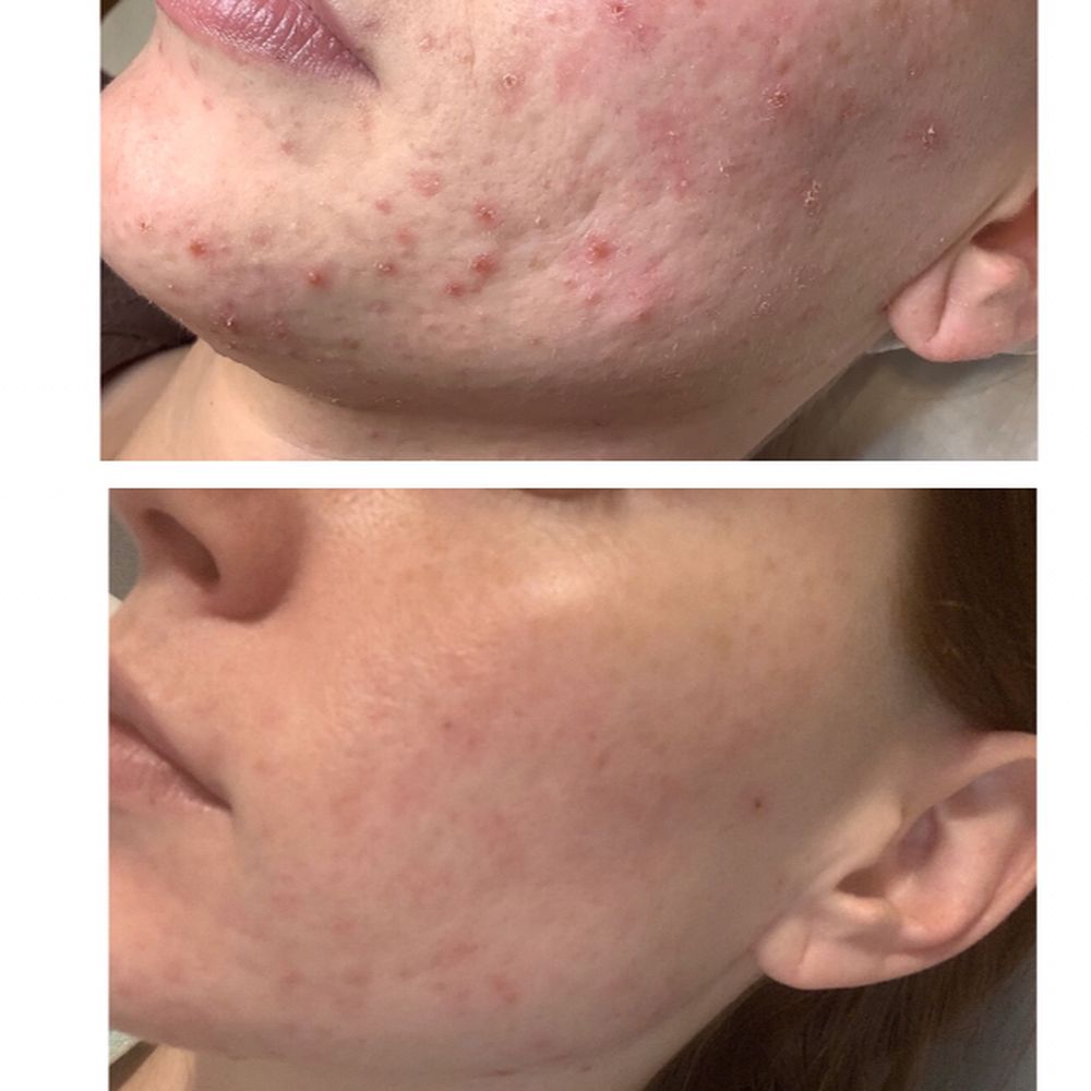 Acne Facial – 60 Minutes