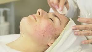 Acne Facial – 75 Minutes