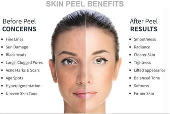 TCA Chemical Peel